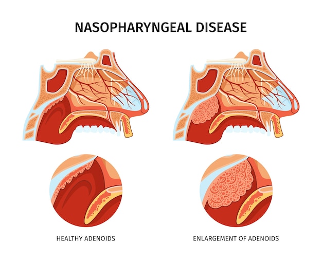 Vector afiche de la enfermedad nasofaríngea con vasos sanguíneos, nervios, senos paranasales, adenoides sanos y agrandados e ilustración vectorial plana