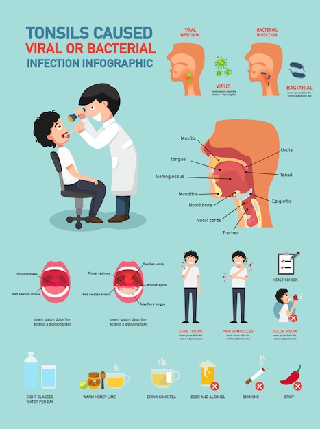 Las amígdalas causaron una infección viral o bacteriana.