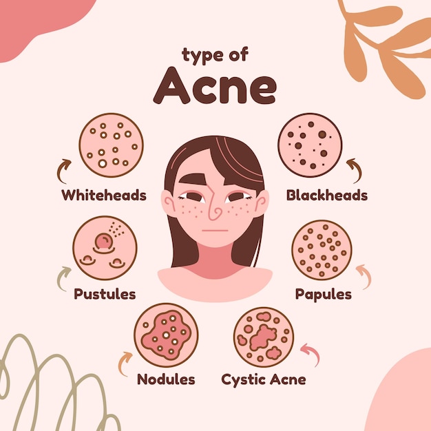 Amplificador rosa marrón ilustrado Tipos de acné Diseño de obras de arte para publicación en Instagram publicación en Facebook publicación en Pinterest