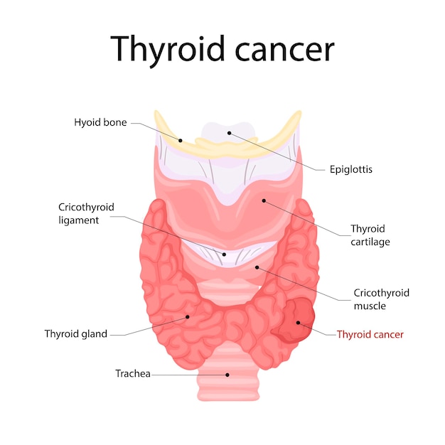 Anatomía del cáncer de tiroides. Icono de anatomía de los órganos del cuerpo humano. Concepto médico.