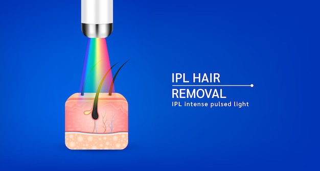 Vector anatomía de las capas de piel con pelos. depilación ligera ipl. no deseado hacer la piel suave