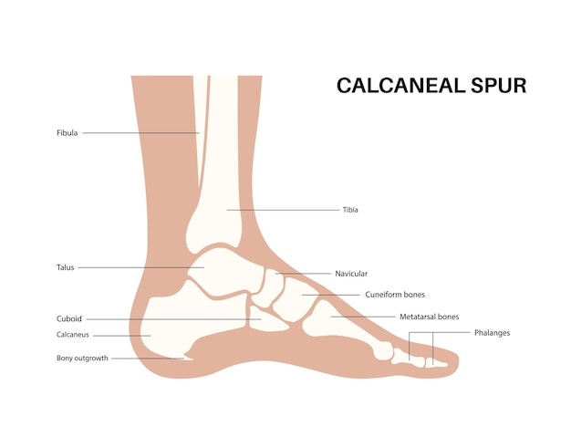 Vector anatomía del espolón calcaneal diagnóstico y tratamiento de problemas del pie en la clínica de podología crecimiento del hueso del talón por tuberosidad calcaneal dolor y hinchazón del tobillo examen por rayos x de los pies ilustración vectorial