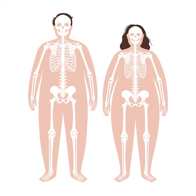 Anatomía del esqueleto obeso