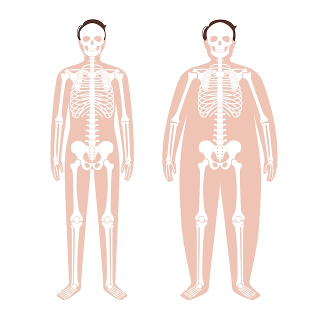 Anatomía del esqueleto obeso