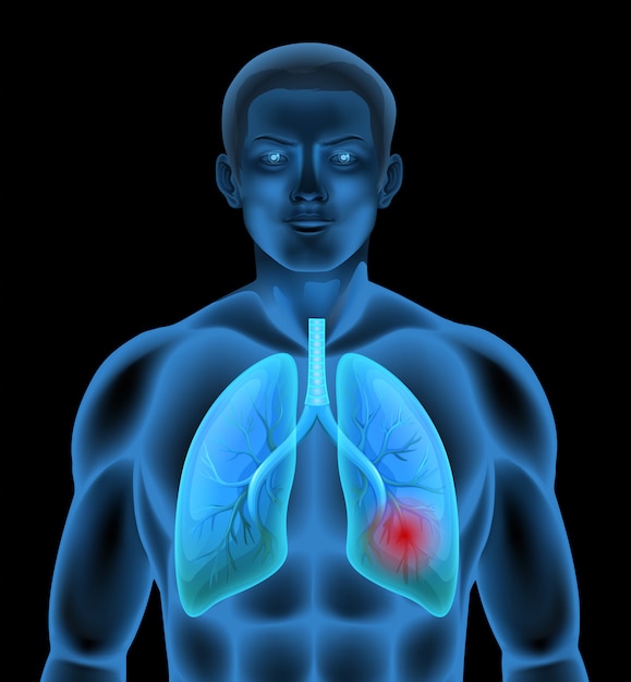 Una anatomía humana de la enfermedad pulmonar