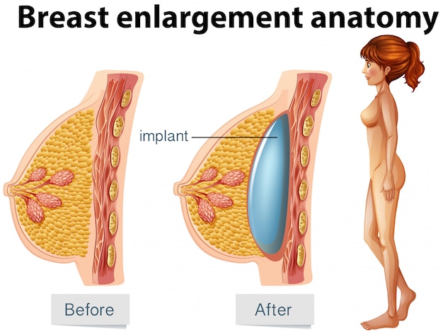 Una anatomía humana del implante mamario