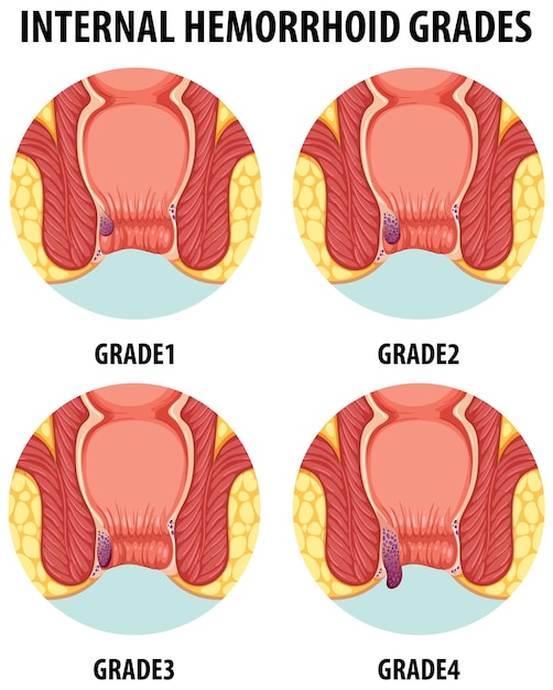 Vector anatomía ilustrada de las hemorroides internas humanas en diferentes grados