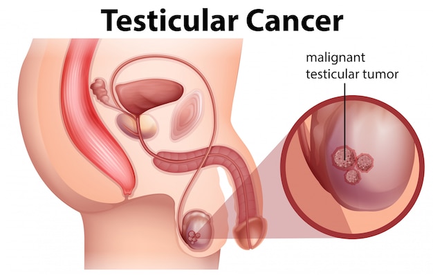 Una anatomía masculina del cáncer testicular