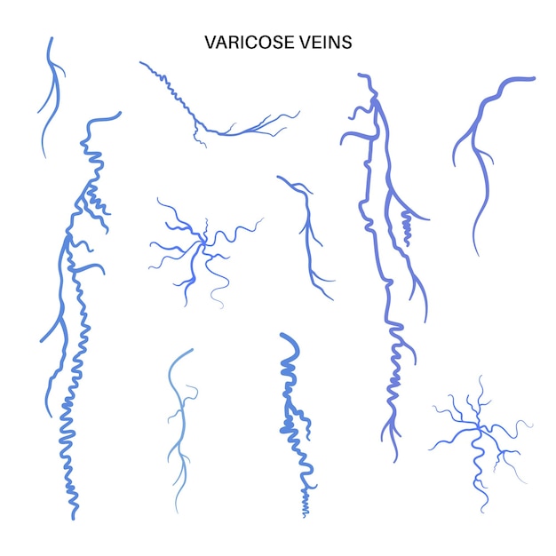 Anatomía de las venas varicosas