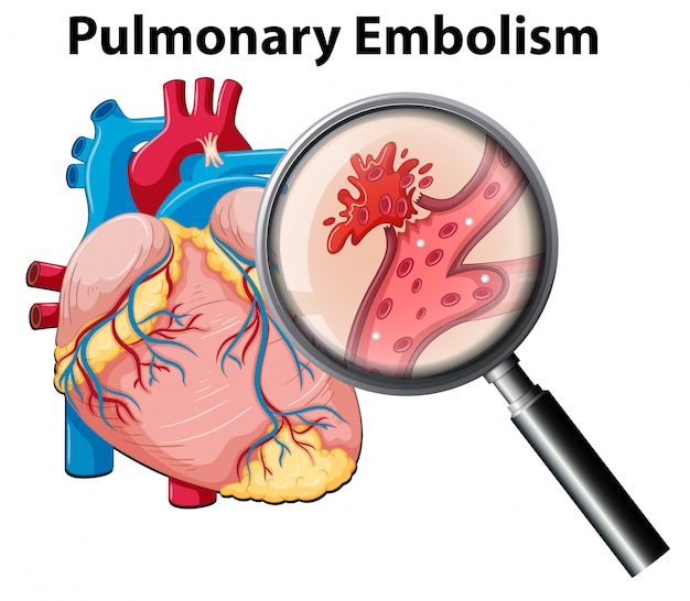 Vector anomonía humana embolia pulmonar