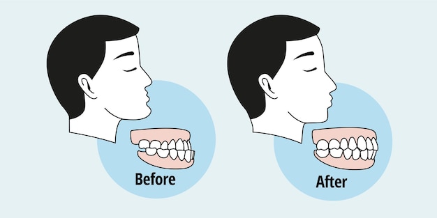 Antes y después del problema dental. Vista lateral del hombre con dientes desalineados. Maloclusión