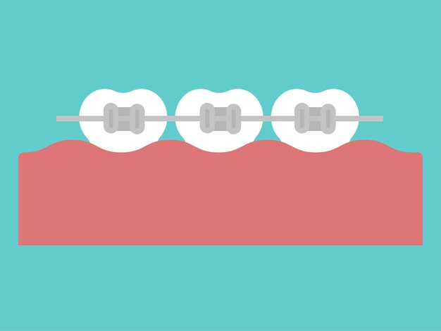 Aparatos metálicos ortodoncia dental Dientes con aparatos ortopédicos. Alineación de mordida de dientes, fila dental con corsé