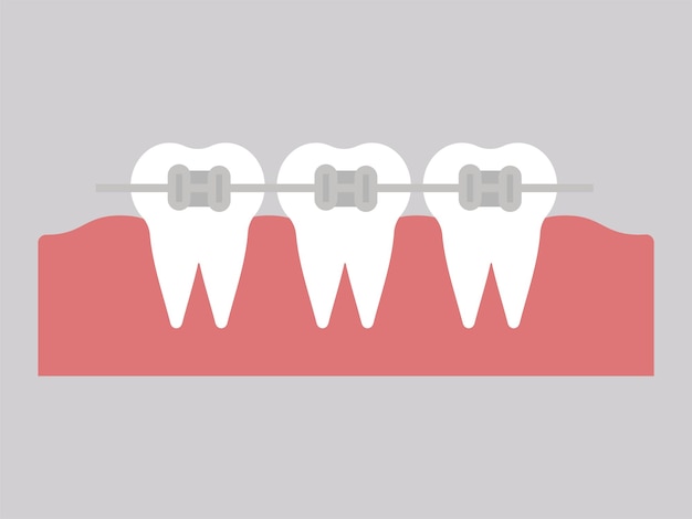 Aparatos metálicos ortodoncia dental dientes con aparatos ortopédicos. alineación de mordida de dientes, fila dental con corsé