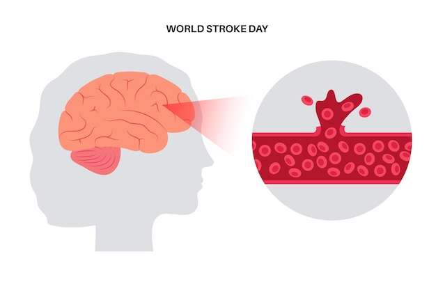 Vector apoplejía cerebral hemorrágica