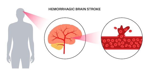 Vector apoplejía cerebral hemorrágica