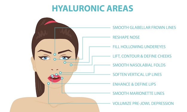 Vector Áreas de inyección facial de ácido hialurónico.