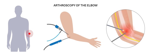 Articulación del codo Cirugía mínimamente invasiva Artroscopia Procedimiento médico Anatomía de los huesos del húmero, cúbito y radio Dolor en el brazo Fractura Osteoartritis o artritis reumatoide Ilustración de rayos X