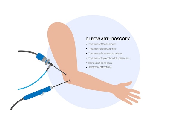 Articulación del codo cirugía mínimamente invasiva Artroscopia procedimiento médico Artroscopio e instrumento artroscópico Dolor en el brazo fractura osteoartritis o tratamiento de artritis reumatoide rayos x