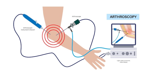 Vector articulación del codo cirugía mínimamente invasiva artroscopia procedimiento médico artroscopio e instrumento artroscópico dolor en el brazo fractura osteoartritis o tratamiento de artritis reumatoide rayos x