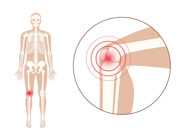 Vector artritis reumatoide o dolor en el icono de la articulación de la rodilla. logotipo de la clínica con rodilla. anatomía del hueso humano