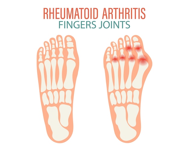 Vector artritis reumatoide osteoartritis de las articulaciones de los dedos de manos y pies concepto médico