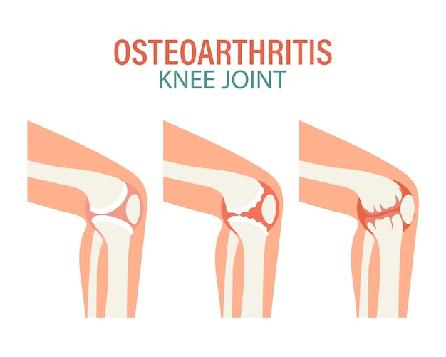 Artritis reumatoide Osteoartritis de las articulaciones de la rodilla Concepto médico Banner de póster infográfico