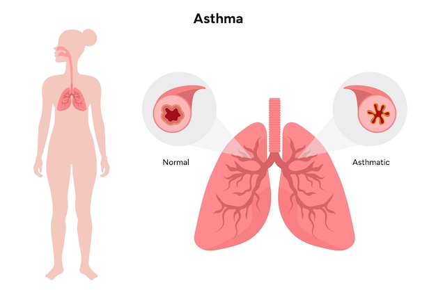 Asma humana de las vías respiratorias asmáticas