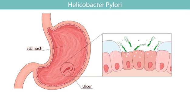 Bacteria verde Helicobacter pylori enfermedad estomacal Ilustración vectorial al estilo de dibujos animados