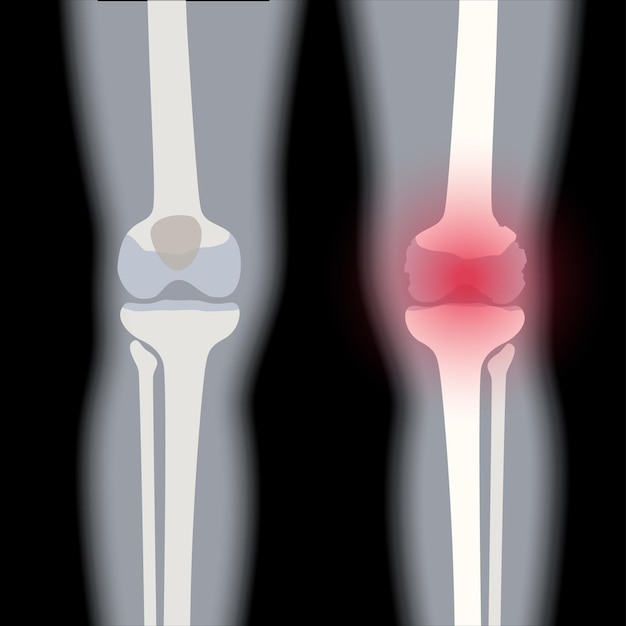 Vector banner de articulación de rodilla de artritis. logotipo de la clínica de artritis reumatoide. dolor en la pierna anatomía del hueso humano