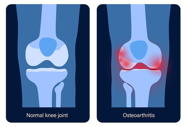 Banner de articulación de rodilla de artritis. Logotipo de la clínica de artritis reumatoide. Dolor en la pierna Anatomía del hueso humano
