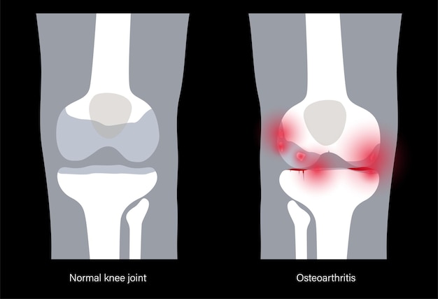 Vector banner de articulación de rodilla de artritis. logotipo de la clínica de artritis reumatoide. dolor en la pierna anatomía del hueso humano