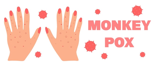 Banner con mono de viruela Monkeypox Manos con una erupción Síntoma de viruela Ilustración vectorial