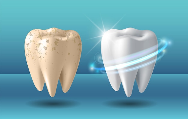 Blanqueamiento dental Comparación de dientes limpios y sucios antes y después del blanqueamiento