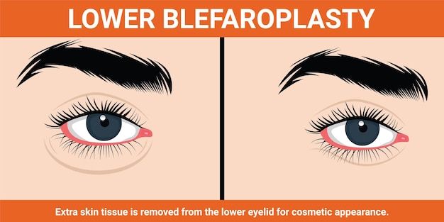 Vector blefaroplastia inferior del párpado antes y después de la ilustración vectorial