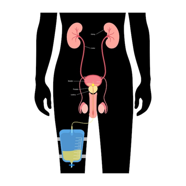 Vector bolsa de drenaje urinario