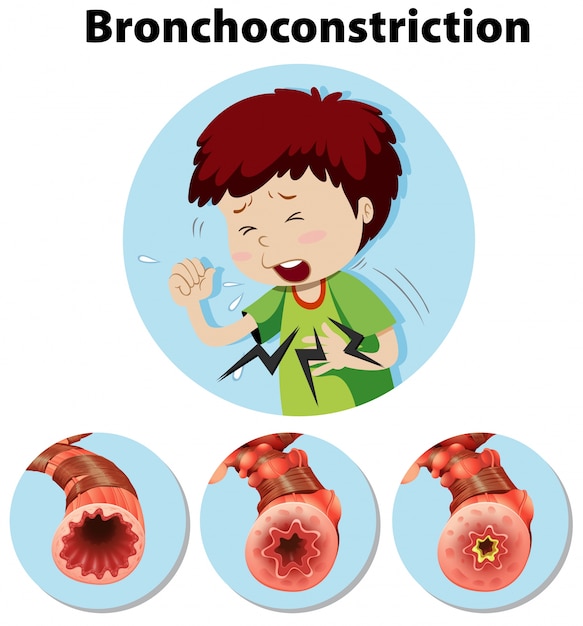 Broncoconstricción de la anatomía humana en el fondo blanco