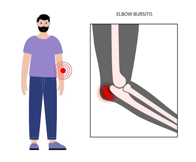 Vector bursitis de codo de estudiante