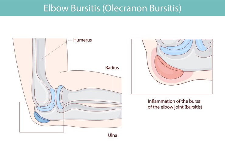 Vector bursitis del codo inflamación de la bursa ubicada debajo del codo ilustración médica vectorial