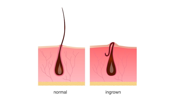 Cabello encarnado después del afeitado, crema o depiladora.