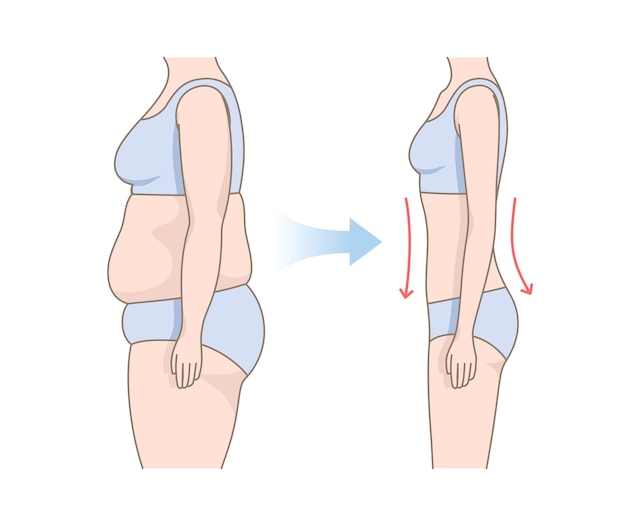 Cambios en el cuerpo de las mujeres antes y después de la gimnasia Cuerpo de mujeres con vientre gordo y delgado Pérdida de peso