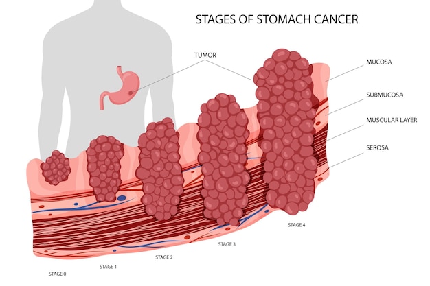 Vector cáncer de estómago etapas de crecimiento tumor canceroso maligno ilustración vectorial anatómica aislada estilo de dibujos animados de fondo blanco