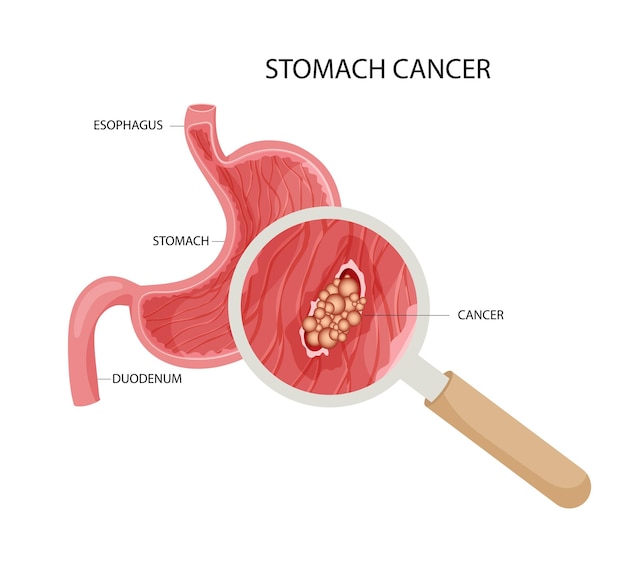 Vector cáncer de estómago tumor canceroso maligno agrandado bajo lupa ilustración vectorial anatómica aislada estilo de dibujos animados de fondo blanco