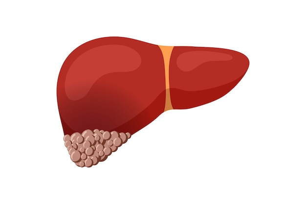 Cáncer de hígado no saludable. Concepto de destrucción de tumores de órganos de glándulas exocrinas humanas. Ilustración plana de oncología de vector