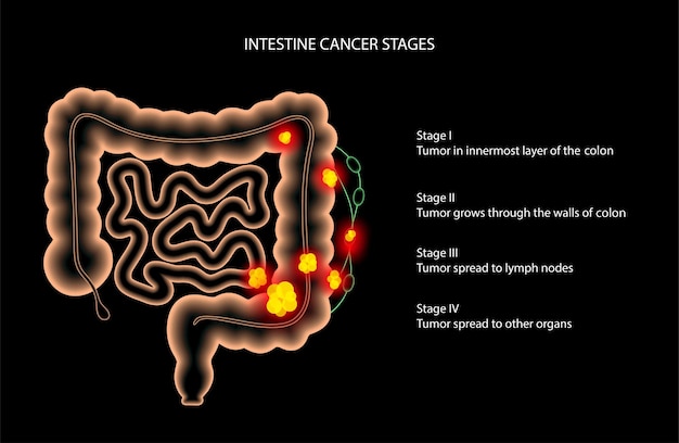 Vector cáncer de intestino 3d