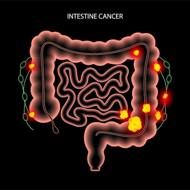 Cáncer de intestino 3D