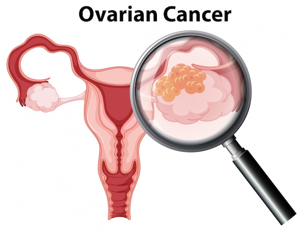 Vector cáncer de ovario en el fondo blanco