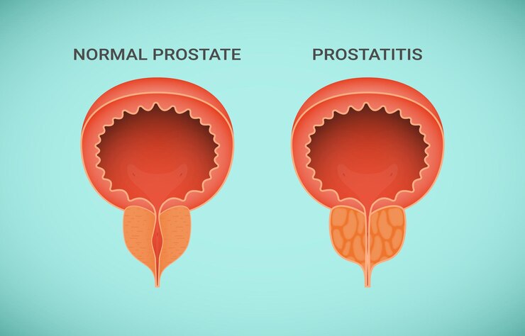Vector cáncer de próstata detiene el dolor normal y agranda la enfermedad oncológica o urológica de la próstata del sistema reproductivo del hombre esquema anatómico vector ilustración realista eps 10