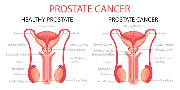 Vector cáncer de próstata sistema reproductor masculino anatomía de los órganos internos del hombre banner infográfico