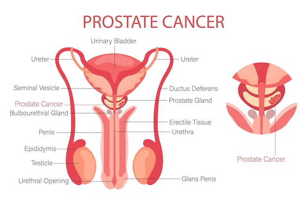 Cáncer de próstata Sistema reproductor masculino Anatomía de los órganos internos del hombre Banner infográfico