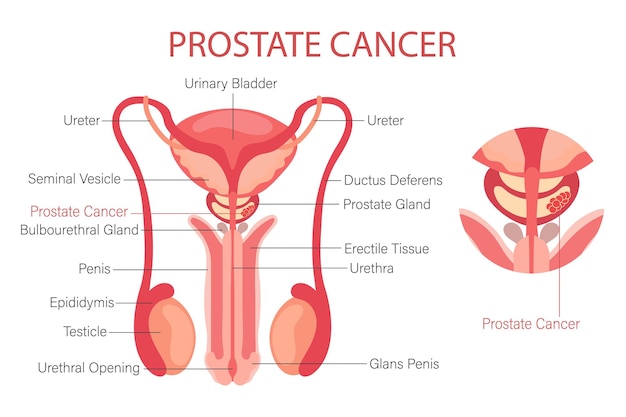 Cáncer de próstata sistema reproductor masculino anatomía de los órganos internos del hombre banner infográfico